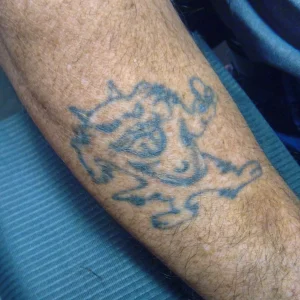 a photo of the 41 year old black ink tattoo before any laser tattoo removal treatments