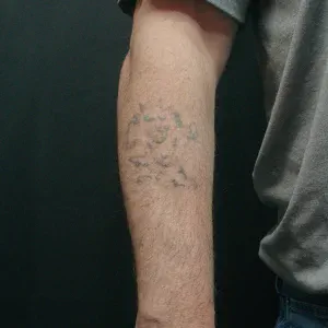 A photo of a 41 year old tazmanian devil tattoo on the arm after two laser tattoo removal treatments, 11 weeks and 13 weeks later.