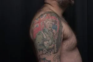 A photo of the shoulder tattoo after one treatment, 12 weeks later.