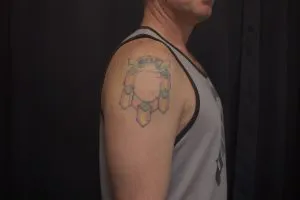 A photo of the crest tattoo on the shoulder after one treatment, 14 weeks later.