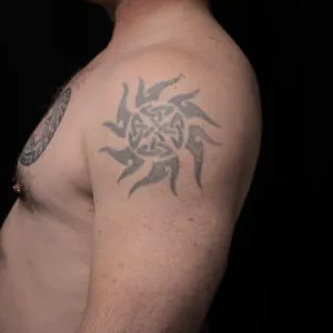 A photo of the sun tattoo on the upper arm, before any laser tattoo removal treatments.