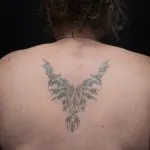 A photo of this tribal tattoo after 1 laser tattoo removal treatment, 13 weeks later