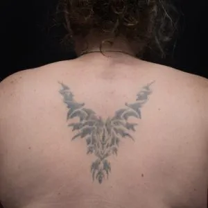 A photo of this tribal tattoo after 1 laser tattoo removal treatment, 13 weeks later