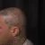 A photo of a 15 months old tattoo on the Scalp on a person with FitzPatrick Skin Type ii. This client is hoping for Complete Removal