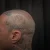 A photo of a 15 months old tattoo on the Scalp on a person with FitzPatrick Skin Type ii 8 Weeks after their  treatment. This client is hoping for Complete Removal