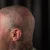 A photo of a 15 months old tattoo on the Scalp on a person with FitzPatrick Skin Type ii 10 Weeks after their  treatment. This client is hoping for Complete Removal
