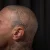 A photo of a 15 months old tattoo on the Scalp on a person with FitzPatrick Skin Type ii 14 Weeks after their  treatment. This client is hoping for Complete Removal