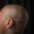 A photo of a 15 months old tattoo on the Scalp on a person with FitzPatrick Skin Type ii 6 Months after their treatment. This client is hoping for Complete Removal