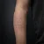 A photo of a Blackwork 41 Years old tattoo on the forearm on a person with FitzPatrick Skin Type iii 9 Months after their  treatment. This client is hoping for Complete Removal